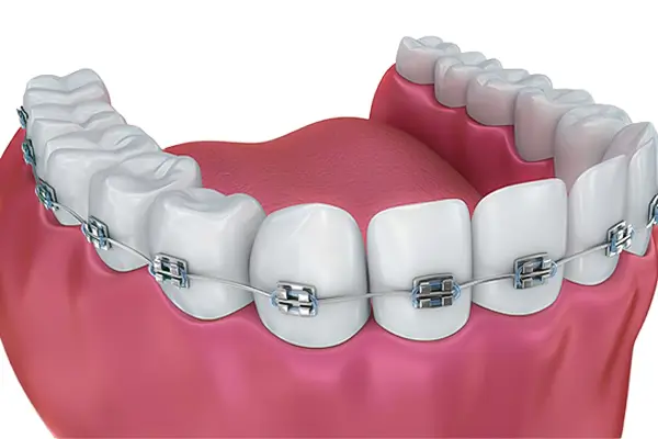 Orthodontic Treatments