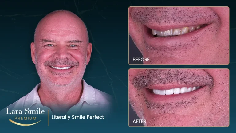Lara Smile Premium - Antalya